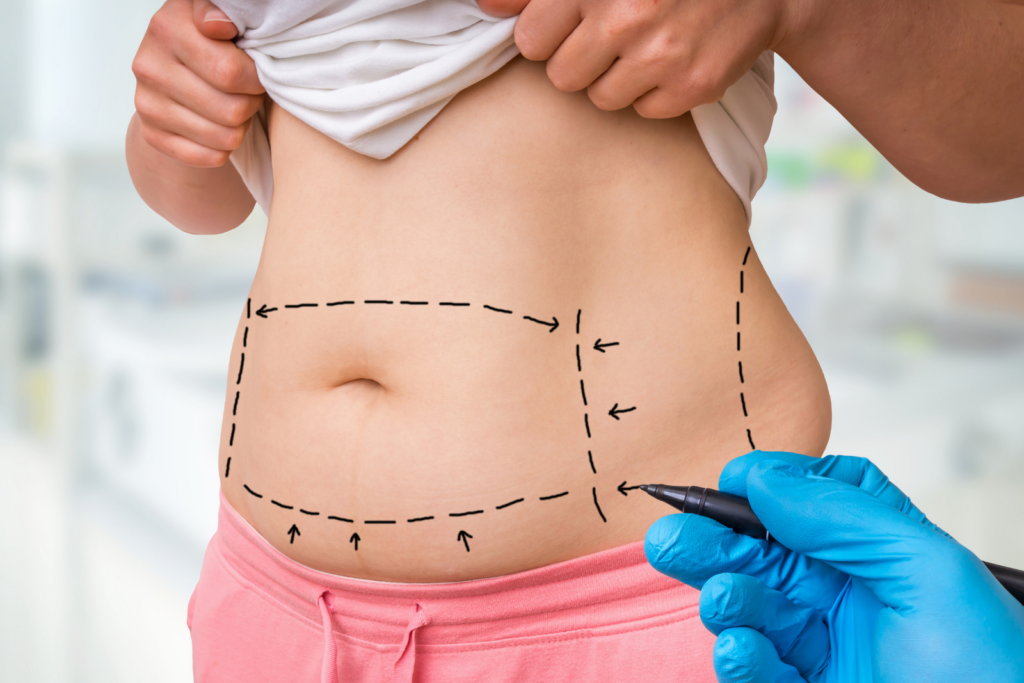 Liposuzione: come funziona davvero, dove agisce e dove no