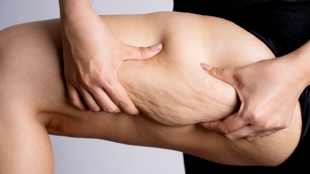 Intralipoterapia
